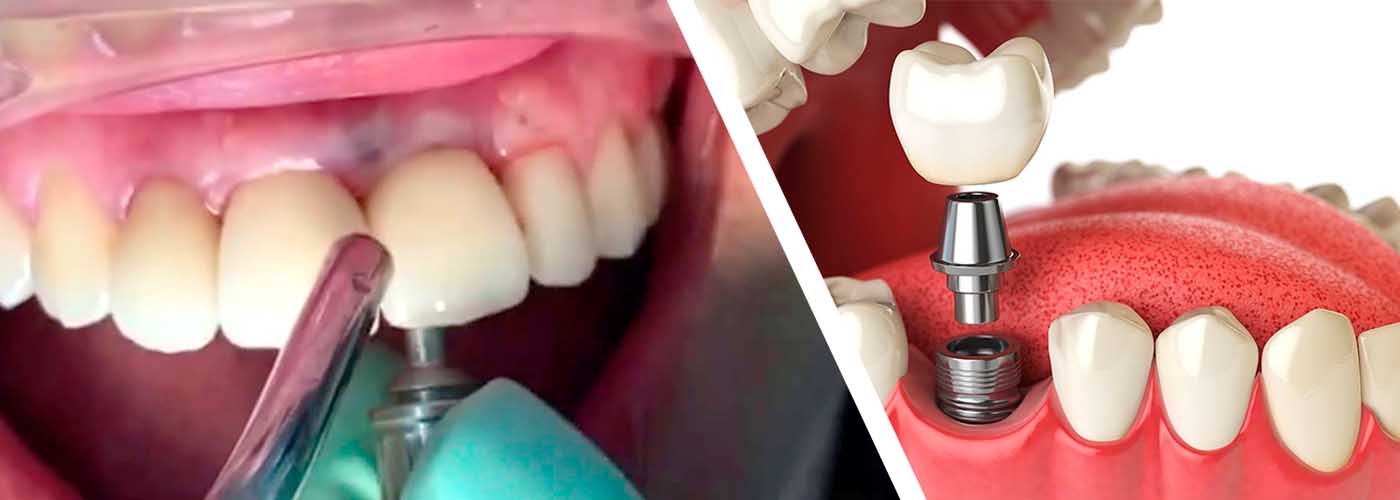 Adhesivos eficaces para prótesis dentales que se mantienen todo el día