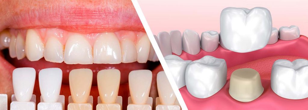 diferencia entre carilla dental y corona dental