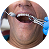 extracciones dentales a domicilio