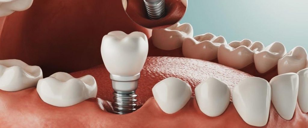 como cuidar los implantes dentales